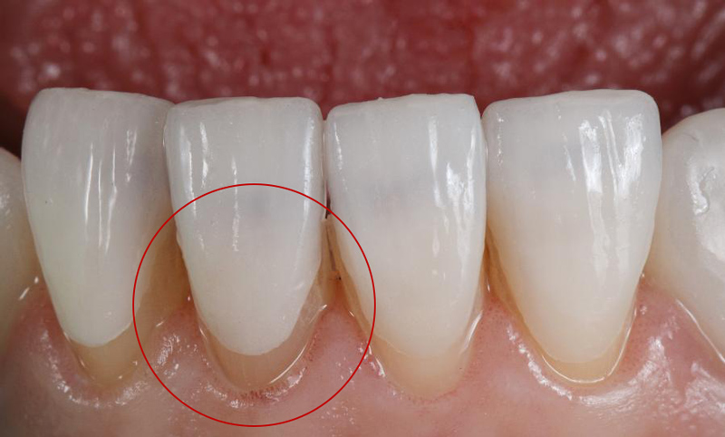 ضخامت کامپوزیت