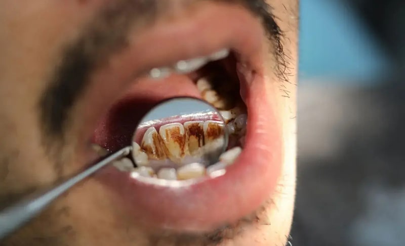 آیا لمینت باعث پوسیدگی دندان میشود