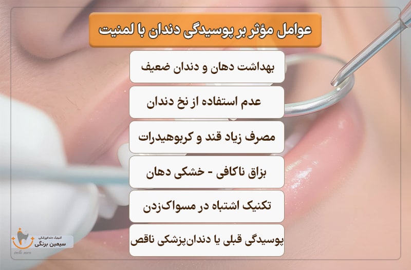 عوامل مؤثر بر پوسیدگی دندان با لمینیت