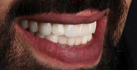 تفاوت روکش زیرکونیا با ایمکس