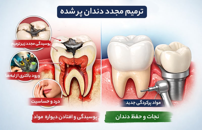 علت ریختن مواد دندان پر شده