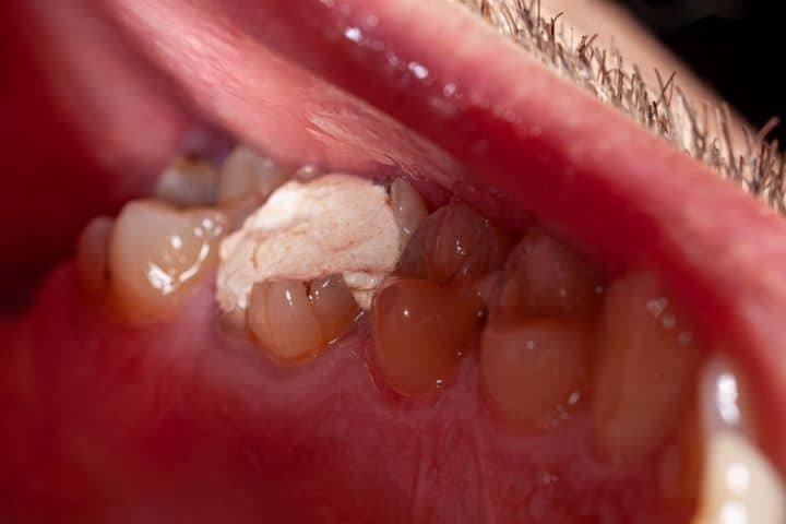 پرکردگی موقت دندان