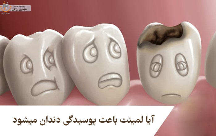 آیا لمینت باعث پوسیدگی دندان میشود