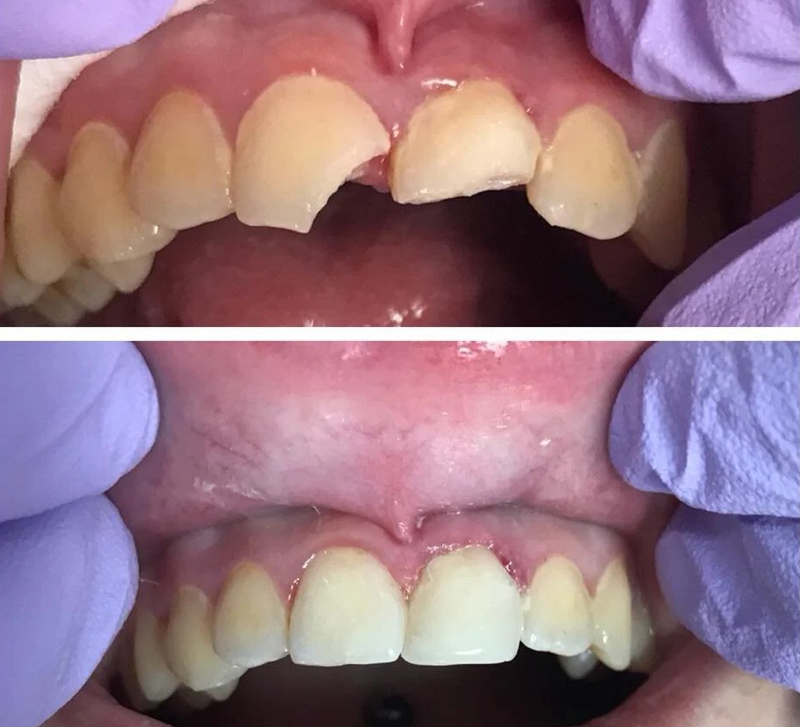 کامپوزیت دندان شکسته