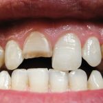 کامپوزیت دندان شکسته جلو