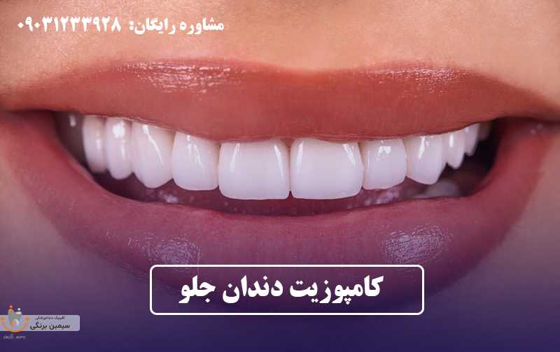 کامپوزیت دندان جلو