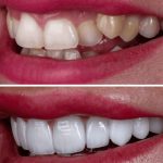 کامپوزیت دندان جلو شامل چند دندان است