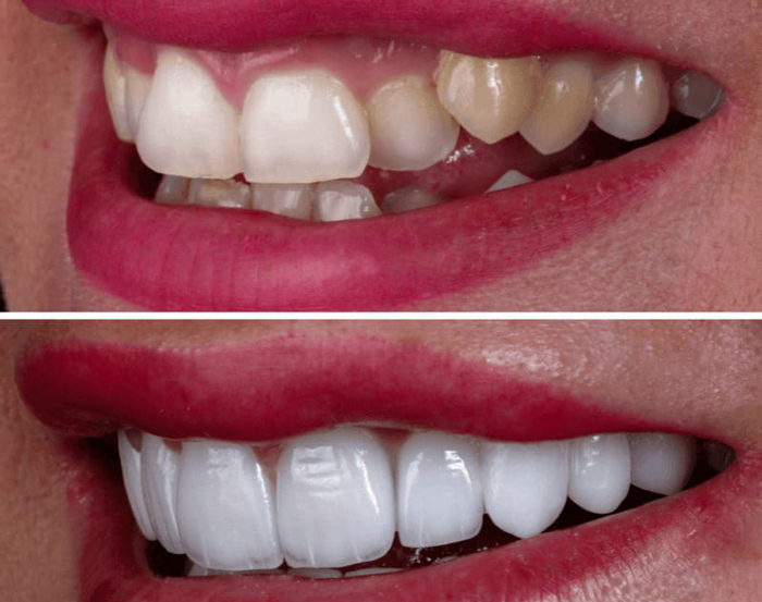 کامپوزیت دندان جلو شامل چند دندان است