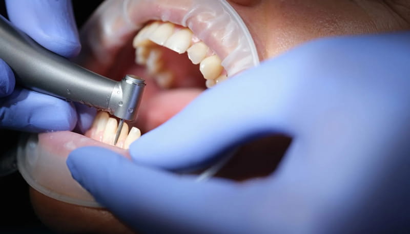 ترمیم دندان درد دارد؟