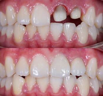 کامپوزیت برای ترمیم دندان جلو