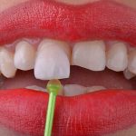 آیا کامپوزیت روی دندان عصب کشی شده امکان دارد؟