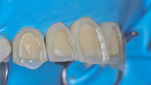 آیا دندان روکش شده را میتوان کامپوزیت کرد
