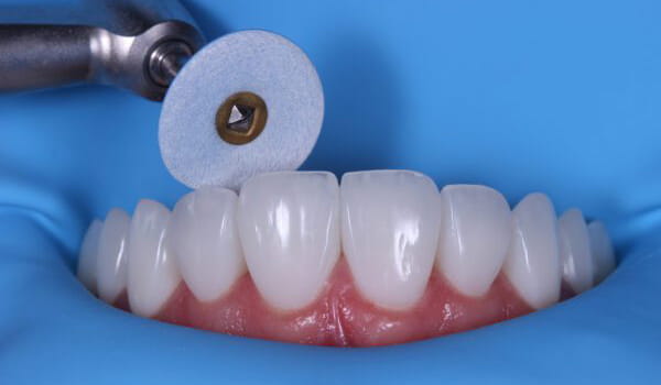 کامپوزیت دندان روکش شده