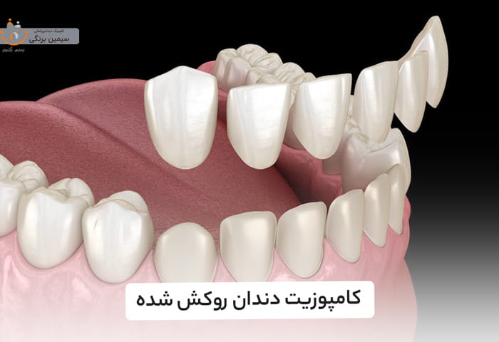 کامپوزیت دندان روکش شده