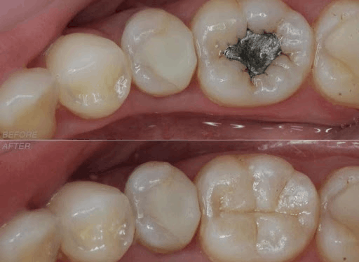 قیمت ترمیم دندان