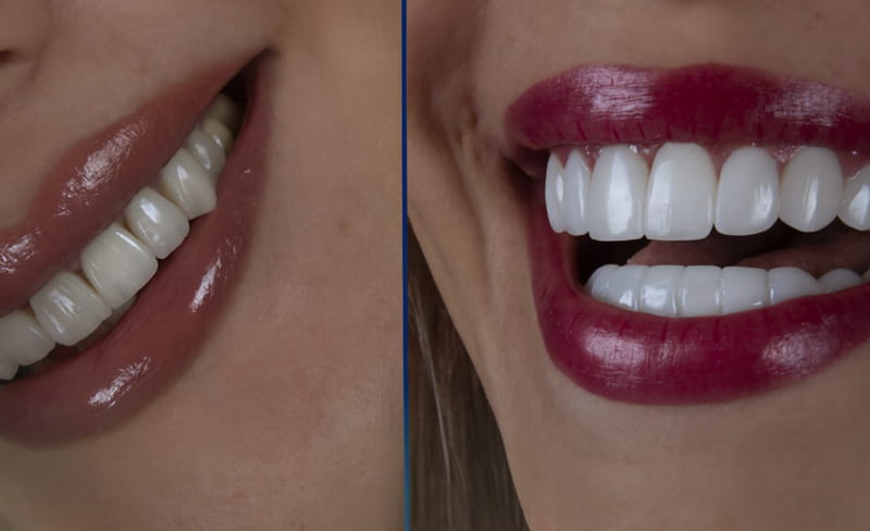 لمینت دندان جلویی