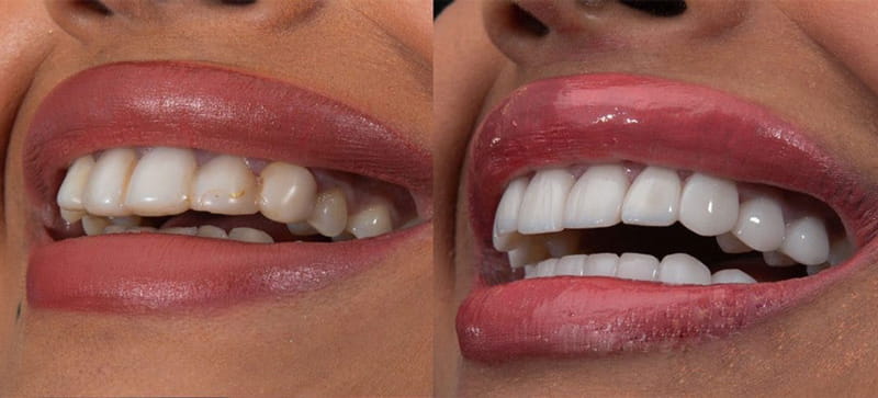 لمینت دندان جلو