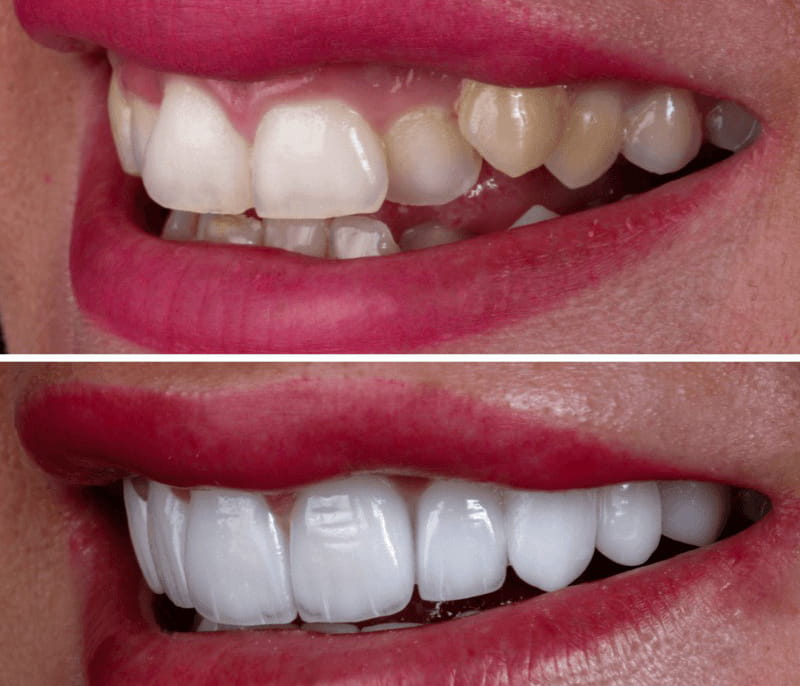 لمینت دندان جلو 