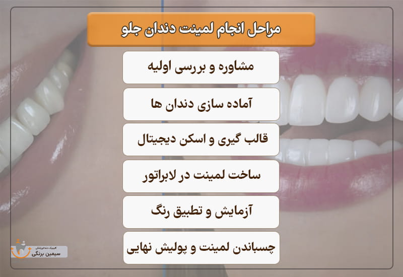 مراحل انجام لمینت دندان جلو