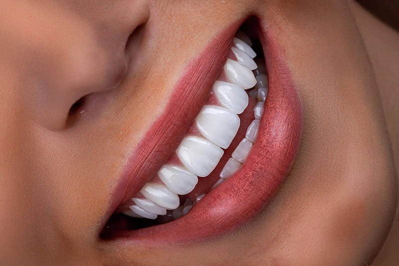 لمینت دندان جلو