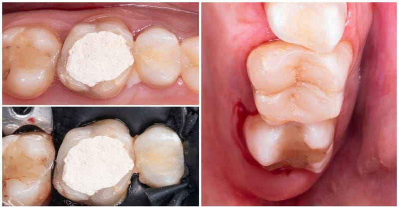 ترمیم دندان درد دارد؟