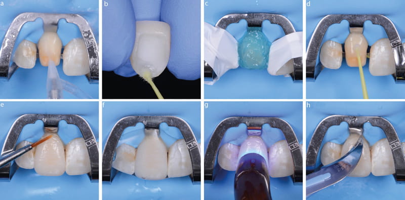 آیا ترمیم دندان درد دارد