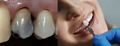 کامپوزیت دندان عصب کشی شده