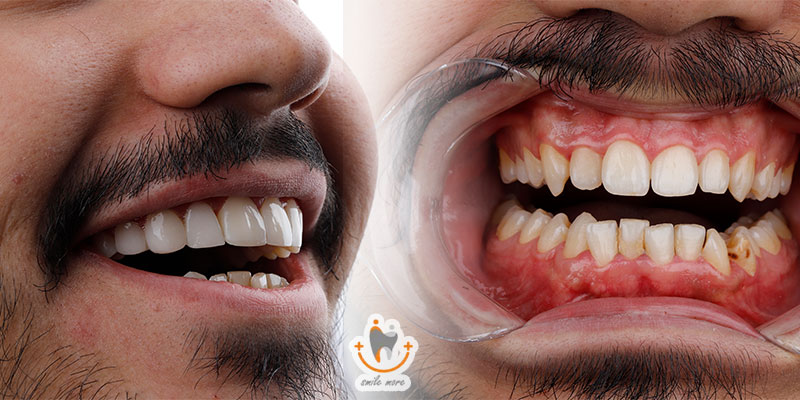 آیا کامپوزیت برای دندان های من مناسب است