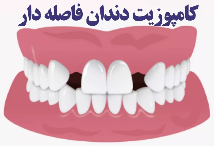 آیا کامپوزیت برای دندان های فاصله دار مناسب است