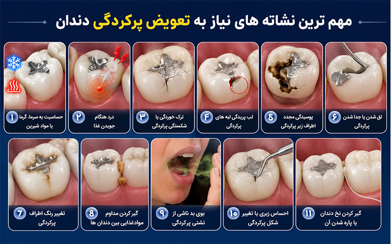 نشانه تعویض پرکردگی دندان